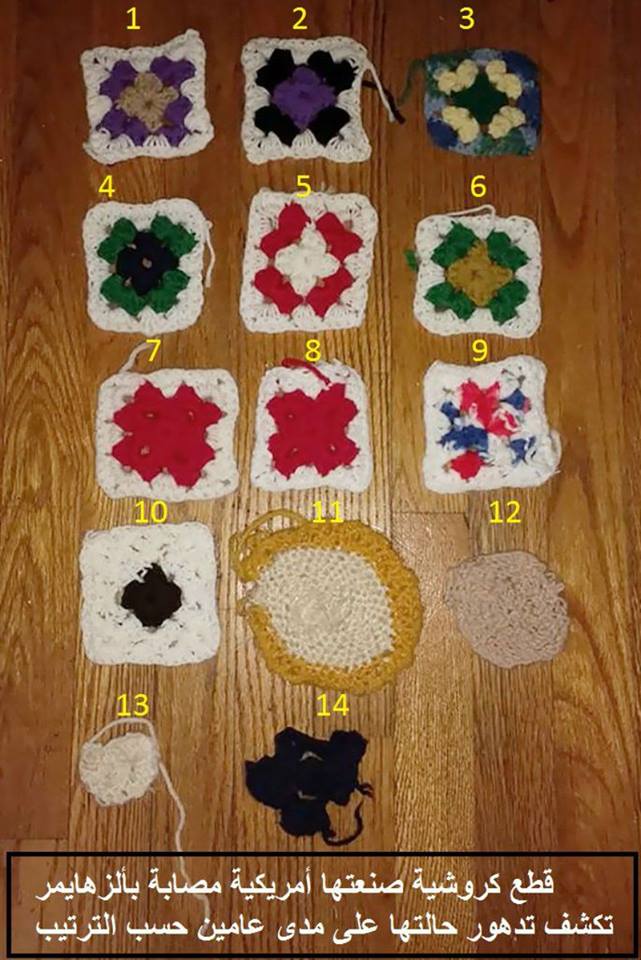 A patient loses the skill of making crochet little by little